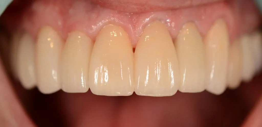 After dental work - good teeth